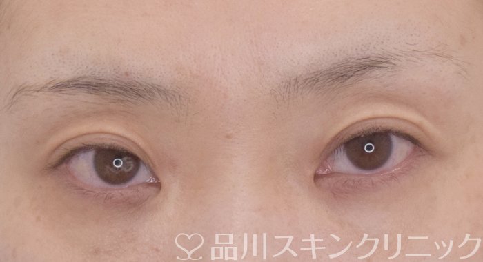 症例NO.64812のBEFORE写真