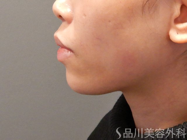 症例NO.73095のAFTER写真