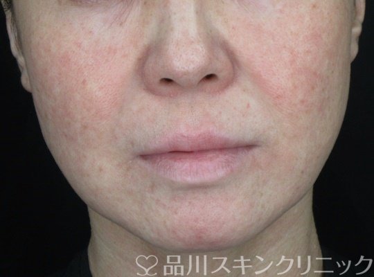 症例NO.70077のBEFORE写真