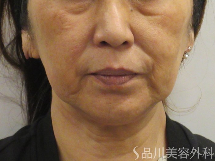症例NO.74936のBEFORE写真