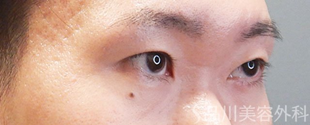 症例NO.72269のBEFORE写真