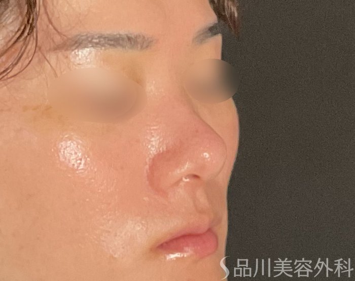 症例NO.74822のBEFORE写真