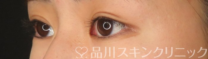 症例NO.65859のAFTER写真