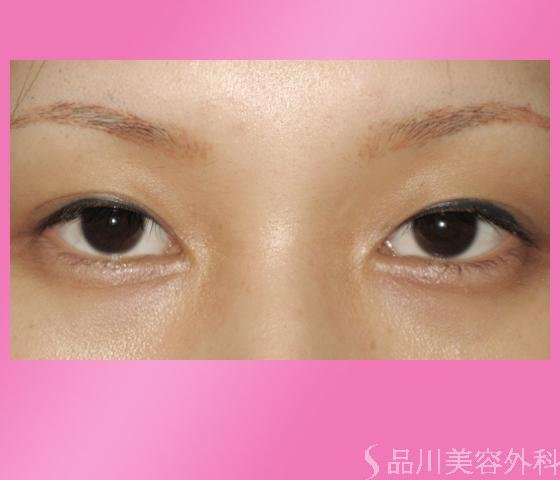 症例NO.1143のBEFORE写真