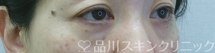 症例NO.69346のBEFORE写真