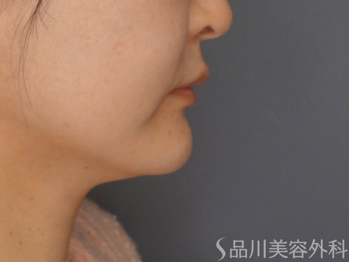 症例NO.69400のAFTER写真