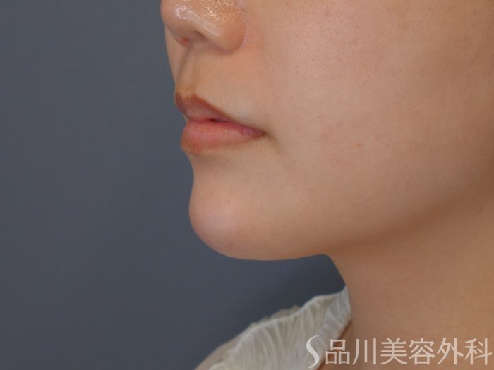 症例NO.71697のAFTER写真