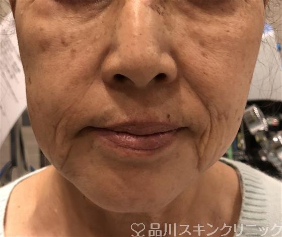 症例NO.32831のBEFORE写真