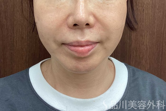 症例NO.71291のAFTER写真