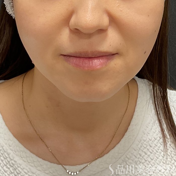 症例NO.75293のBEFORE写真