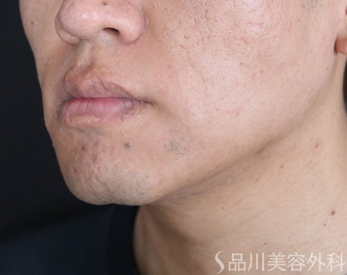 症例NO.74015のBEFORE写真