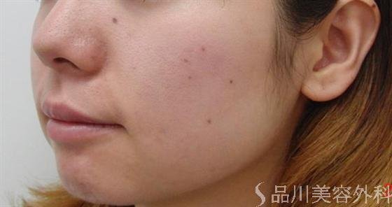 症例NO.5026のBEFORE写真