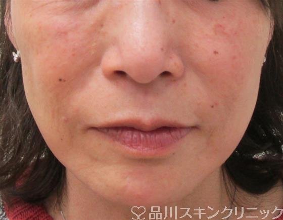 症例NO.30995のAFTER写真