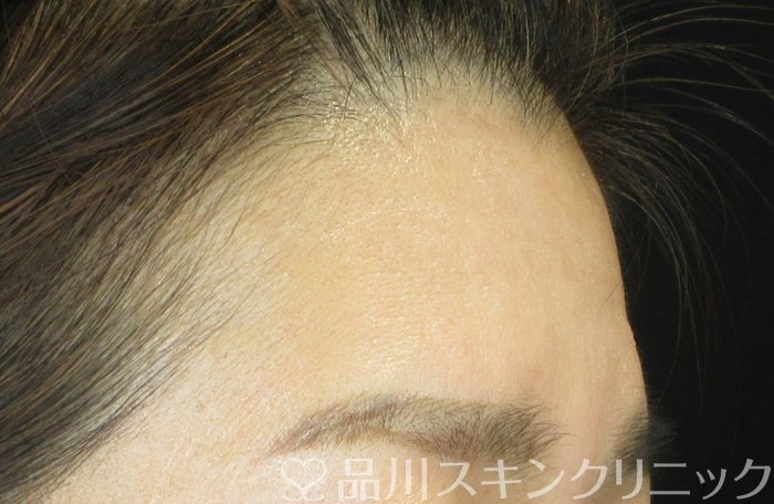 症例NO.65375のBEFORE写真