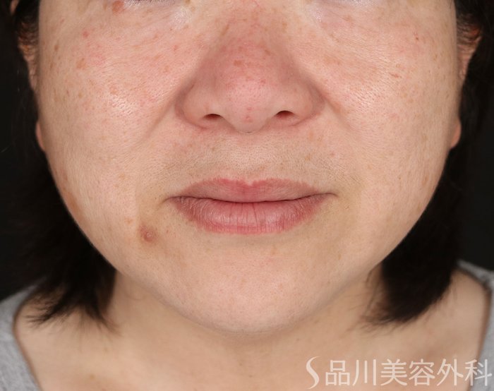 症例NO.73674のBEFORE写真