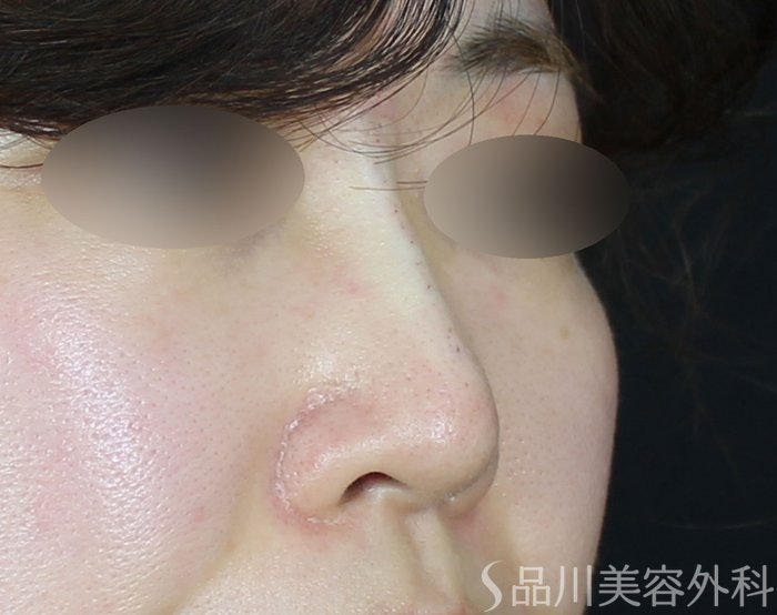 症例NO.71606のAFTER写真