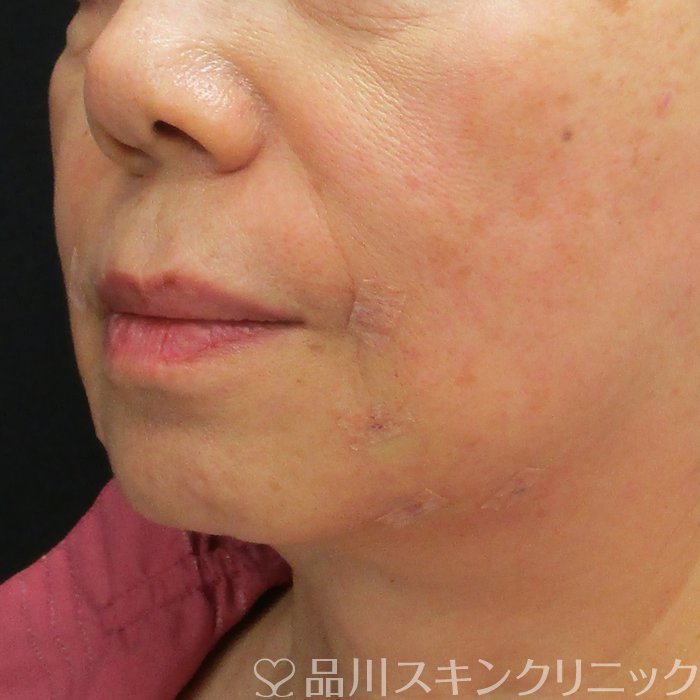 症例NO.75120のAFTER写真