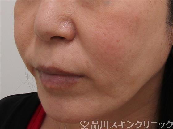 症例NO.36443のBEFORE写真