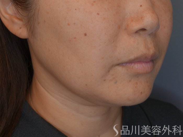 症例NO.67169のBEFORE写真