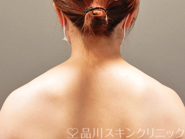 症例NO.69431のBEFORE写真