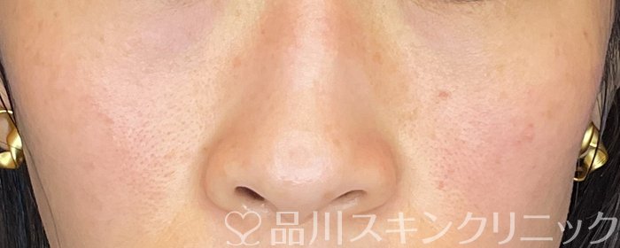 症例NO.73918のAFTER写真