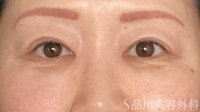 症例NO.65046のAFTER写真