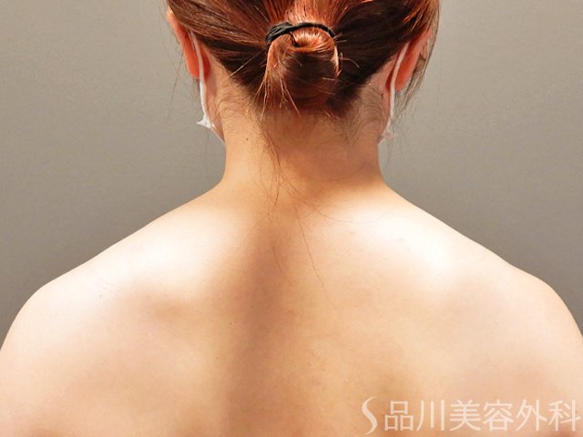 症例NO.69431のBEFORE写真