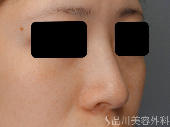 症例NO.74933のBEFORE写真