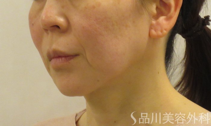 症例NO.73221のBEFORE写真