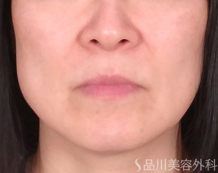 症例NO.70153のBEFORE写真