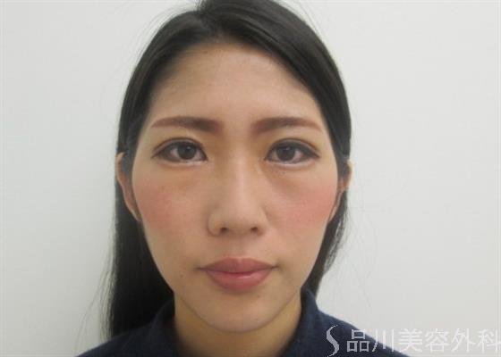 症例NO.26472のAFTER写真