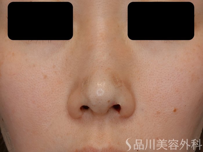 症例NO.72974のAFTER写真