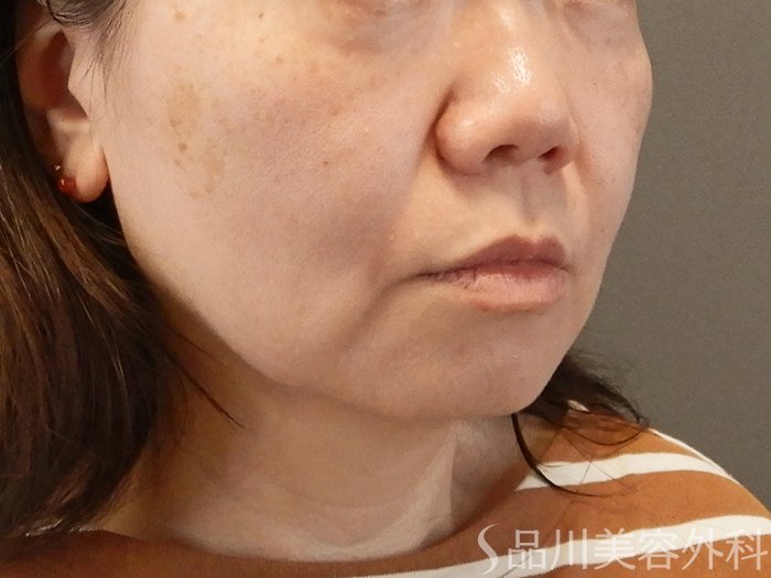 症例NO.67900のBEFORE写真