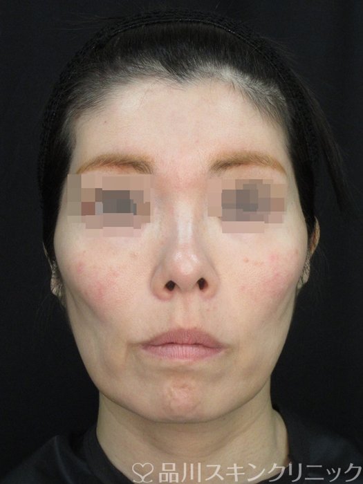 症例NO.72462のBEFORE写真