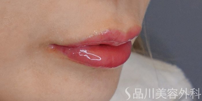 症例NO.72139のAFTER写真