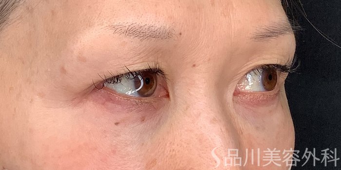症例NO.71230のBEFORE写真