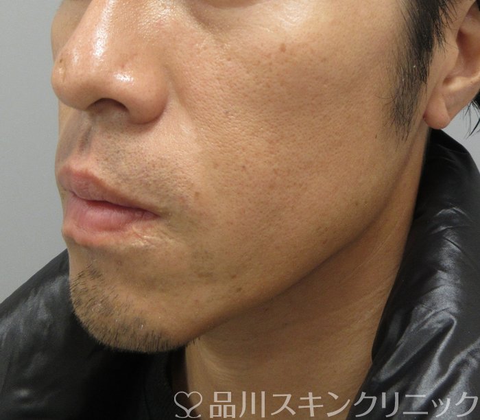 症例NO.74732のAFTER写真
