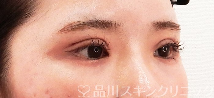 症例NO.62185のAFTER写真