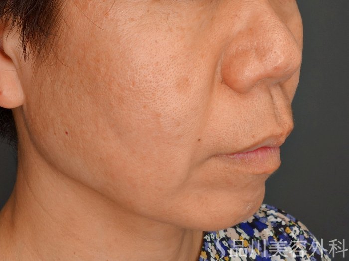 症例NO.74049のBEFORE写真