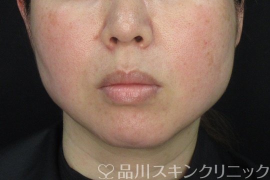 症例NO.72676のAFTER写真