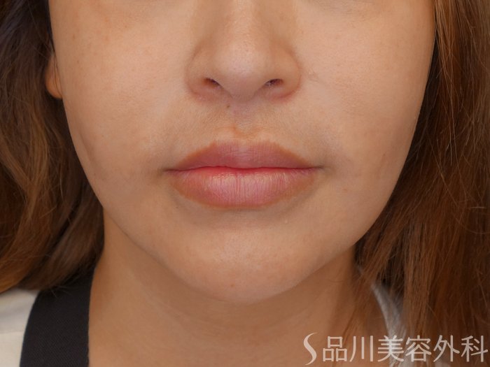 症例NO.70898のBEFORE写真