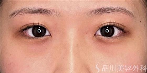 症例NO.53277のBEFORE写真