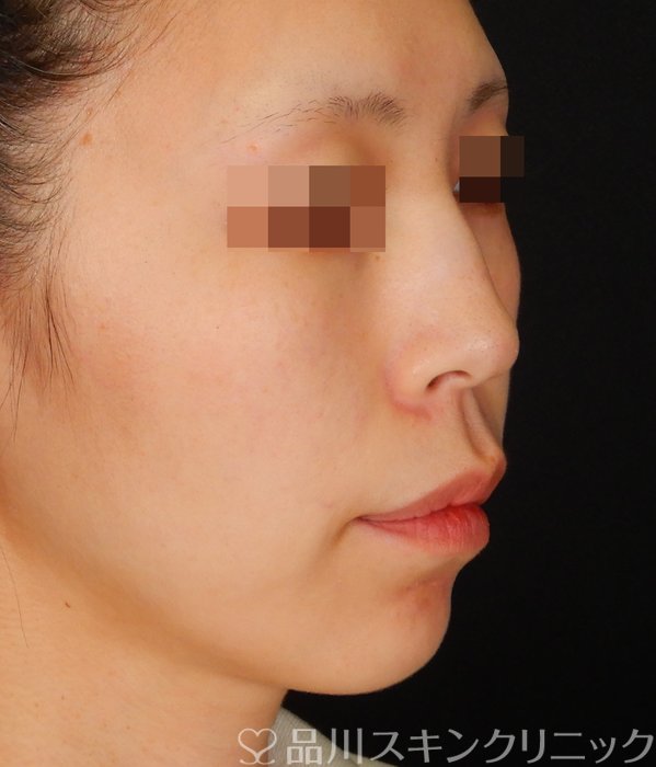 症例NO.65325のBEFORE写真