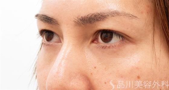 症例NO.57327のAFTER写真