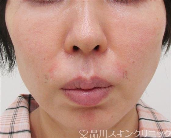 症例NO.30749のAFTER写真
