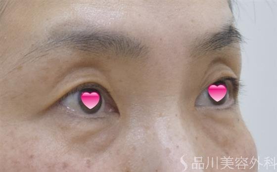 症例NO.54461のBEFORE写真