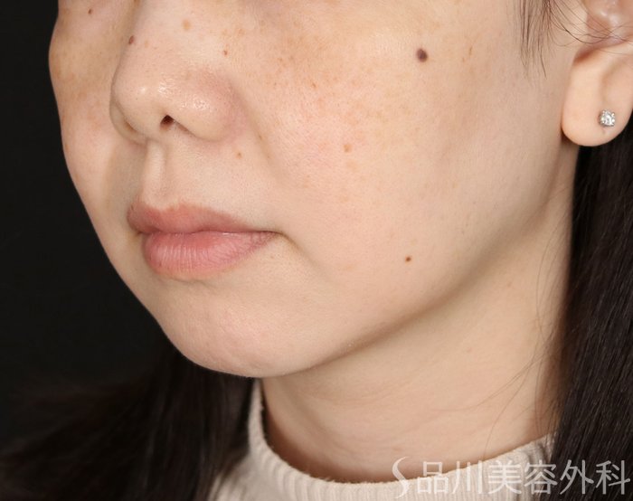 症例NO.72039のBEFORE写真