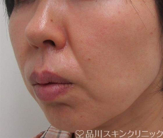 症例NO.30749のBEFORE写真