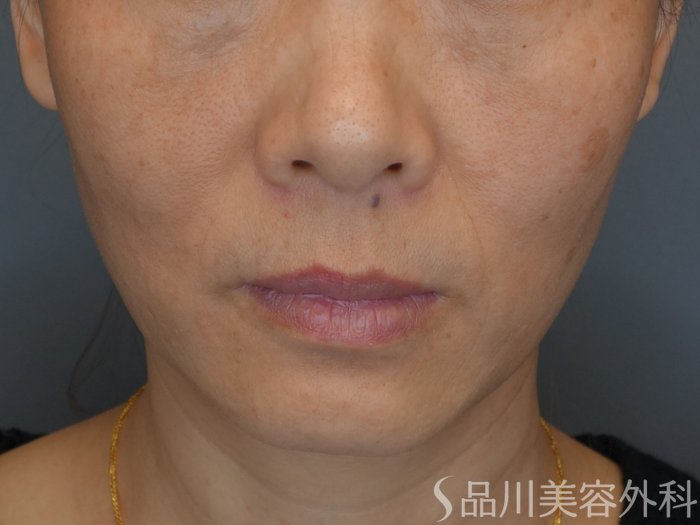 症例NO.73939のBEFORE写真