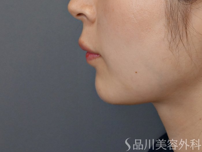 症例NO.70164のBEFORE写真